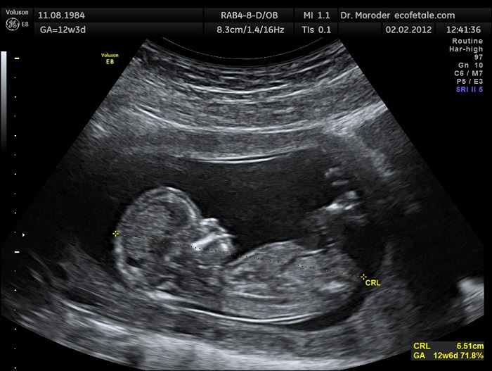 Ultrason Bizlere Bebeğimizin İlk Fotoğraflarını Verdi Peki Körlüğe Çözüm Olabilir mi?